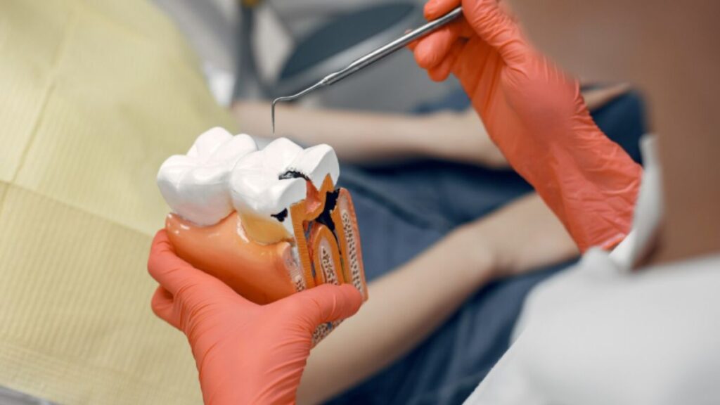 Root Canal