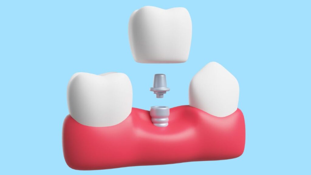 Dental Crowns