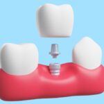 How Dental Crowns Safeguard Your Teeth And Restore Your Smile