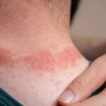 Understanding Betametacron: Uses, Benefits, and Side Effects