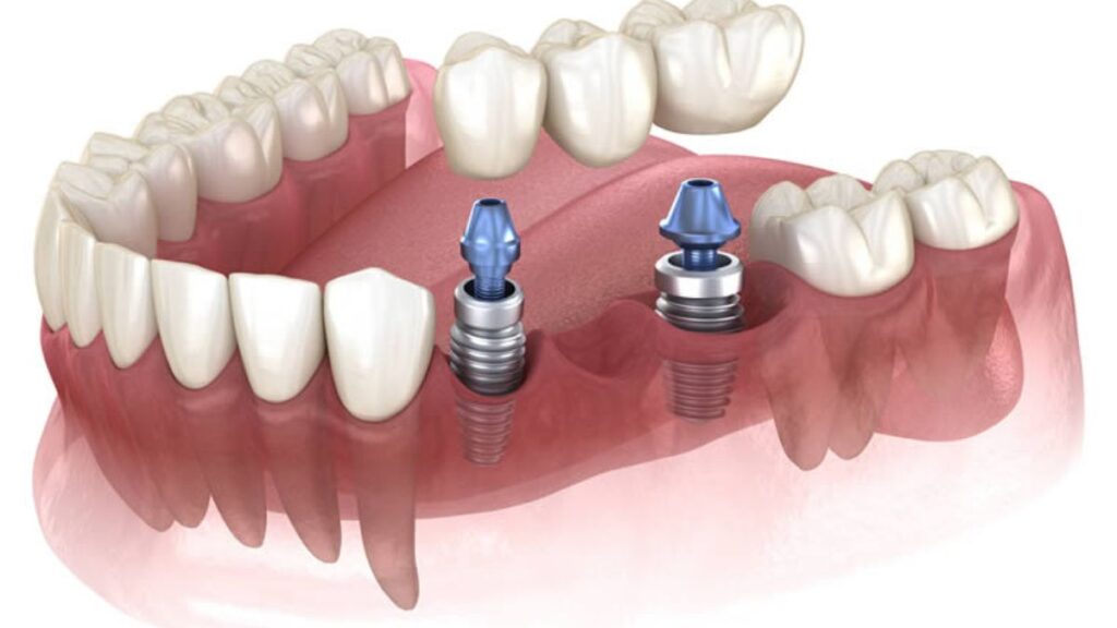 Affordable Dental Implant Services