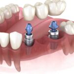 Affordable Dental Implant Services Available at Nearby Local Clinics