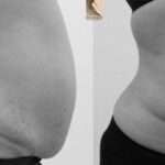 Reshape Your Silhouette: The Non-Invasive Solution for Stubborn Fat