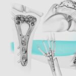 A Closer Look at Orthopedic Implants: Innovations and Benefits