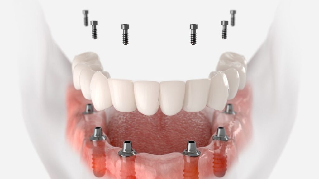 Dental Implants
