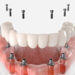 Dental Implants: Essential Insights for Prospective Patients