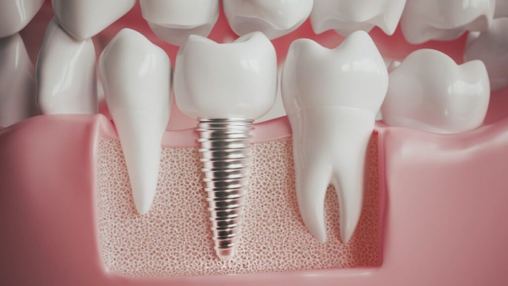 Dental Implants