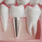 Rebuilding Smiles, Restoring Confidence with Dental Implants