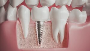 Dental Implants