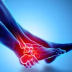 Treatment Options When Joint Surfaces in the Ankle Are Damaged